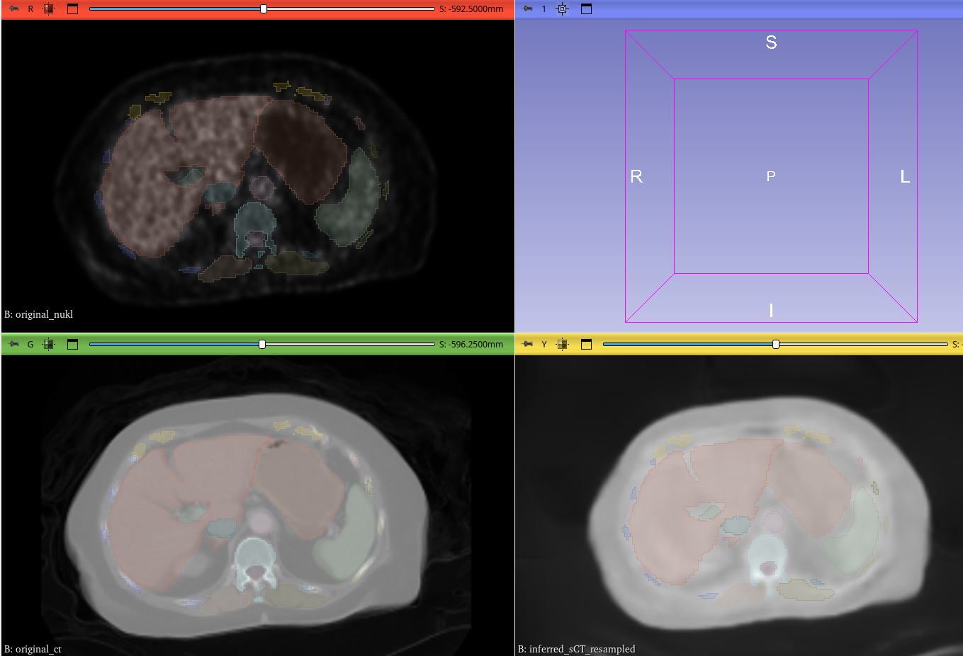 Comparison of PET, original CT, and synthetic CT scans